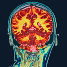Colored coronal magnetic resonance imaging (MRI) scan of the brain of a healthy.